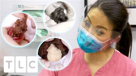 dr pimple popper soap2day|50 Minutes of Blackheads! Clusters of Blackheads with Dr..